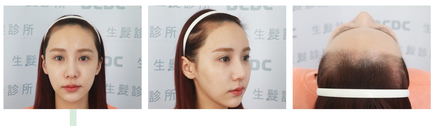 髮際線術前稀疏感重